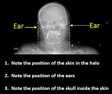 Position of Scalp in Halo