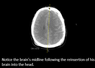 After picture of Midline of Brain